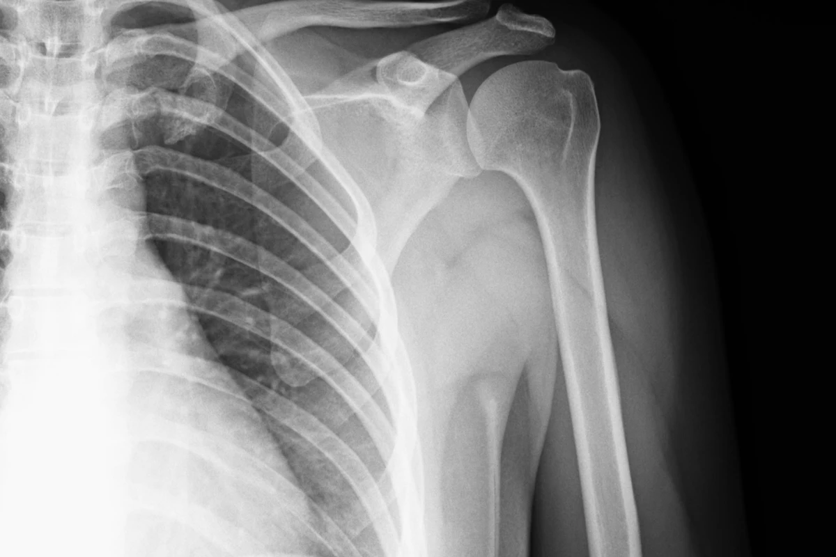 Radiografía de hombro y brazo en la que se distinguen la cabeza del húmero, la clavícula y las costillas